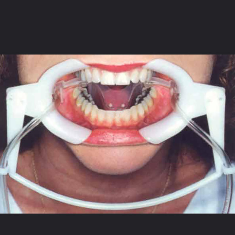  Abrebocas Dental con Retractor de Mejillas y Tubos de Aspiraci&oacute;n de Saliva